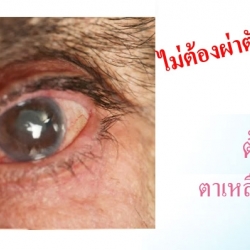 ศูนย์รักษาดวงตา ปัญหาต้อตา ตาเหลือง